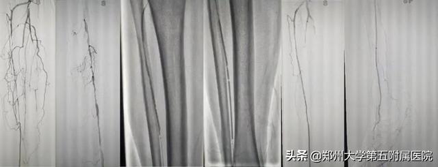 糖尿病脚起泡脱皮(糖尿病脚起泡脱皮图片)