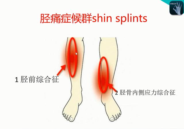 髋关节疼痛与膝盖的关系，膝盖疼当是“风湿关节炎”