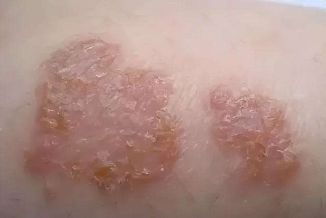 得了湿疹不要怕湿疹也有克星，这3个治疗方法或能派上大用场