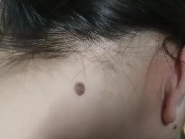 突然长黑色肉痣是什么原因，皮肤上这种痣十有八九是黑斑息肉