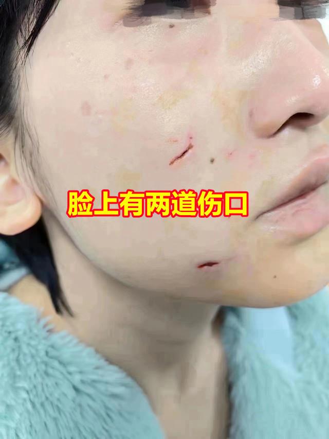 女子逗狗被咬后续，女网红擅自逗狗被咬伤脸