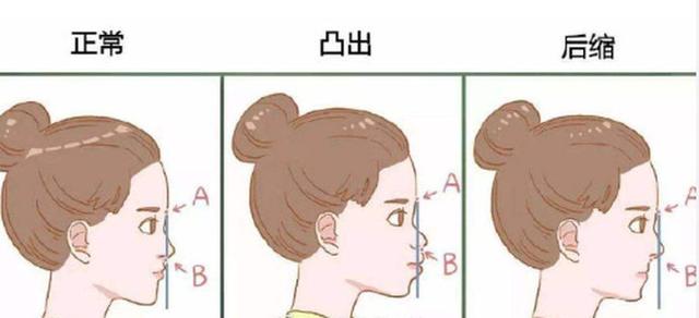 怎样才算是凸嘴，几个技巧教你判断自己是否凸嘴