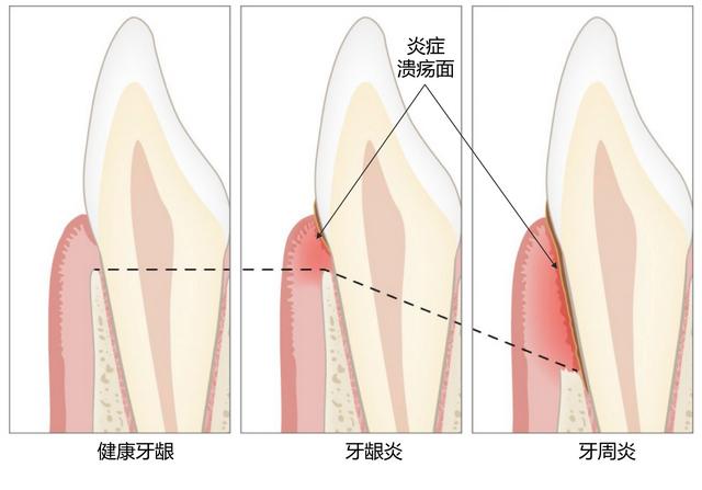 第一次洗牙疼不疼，洗牙疼不疼大概多长时间（分享一下第一次洗牙的经历和感受）