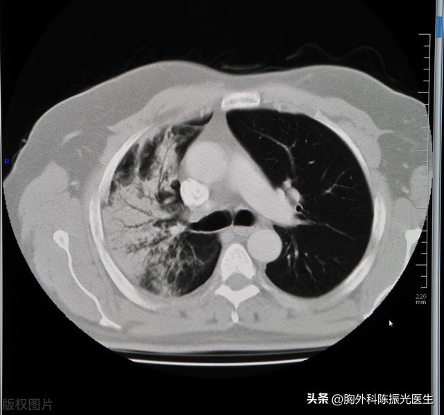 糖尿病有结节(糖尿病结节性肾小球硬化)