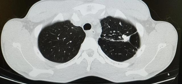 肺结核的分型诊断标准，肺结核的分型及影像学表现