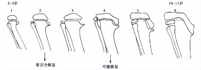 内旋型肥胖(内旋体是什么)