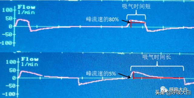 5个呼吸机常见参数设置，呼吸机各种模式需要调的参数（送给临床小白——呼吸机模式及参数设置图文详解）