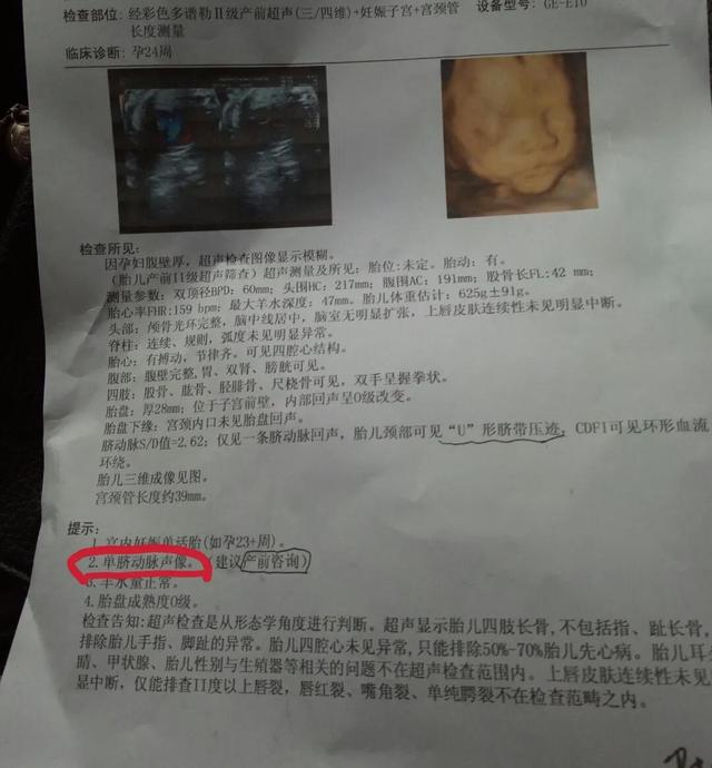单脐糖尿病(单糖糖尿病)