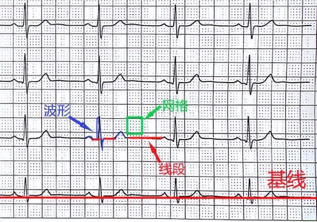 心电图怎么看图解，心电图基础图解（心电图怎么看心电图入门讲解一）