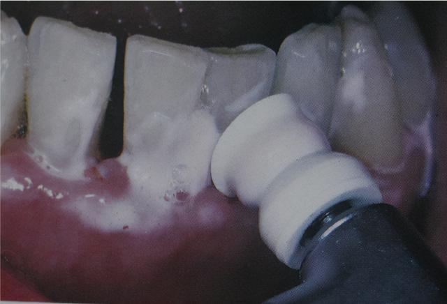 第一次洗牙疼不疼，洗牙疼不疼大概多长时间（分享一下第一次洗牙的经历和感受）