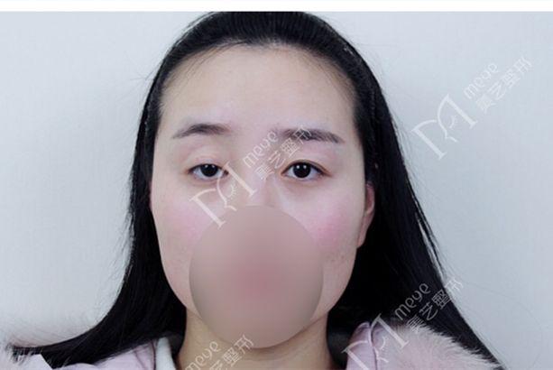 大小眼自我矫正方法，大小眼矫正方法（如何矫正大小眼）