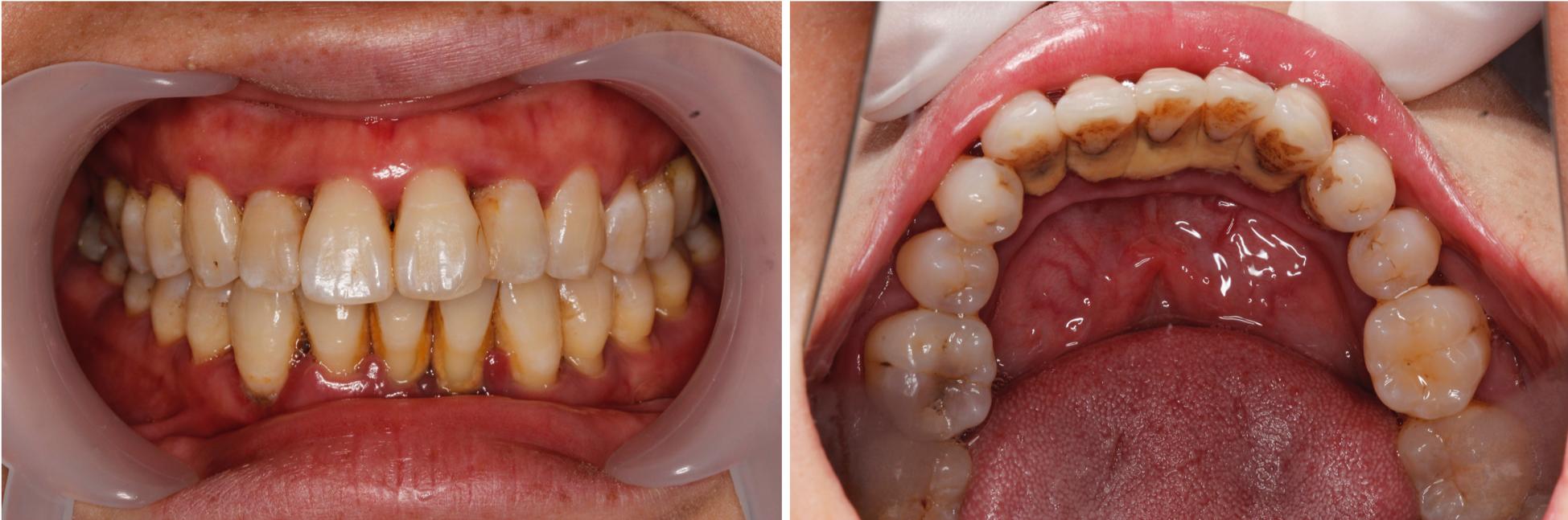 第一次洗牙疼不疼，洗牙疼不疼大概多长时间（分享一下第一次洗牙的经历和感受）