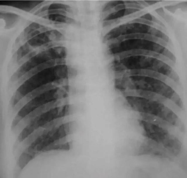 肺结核的分型诊断标准，肺结核的分型及影像学表现