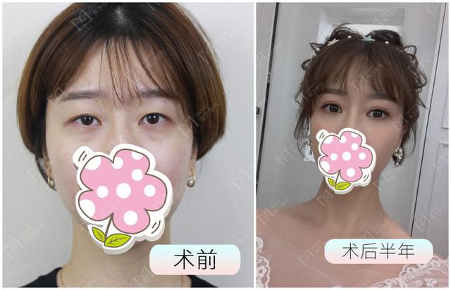 大小眼自我矫正方法，大小眼矫正方法（如何矫正大小眼）