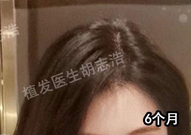 一图解析植发手术全流程，揭秘植发手术的全过程