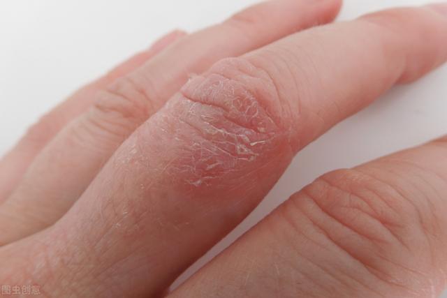 皮肤瘙痒起红斑是何原因如何治疗，皮肤出现红斑皮疹