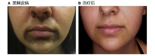 上唇皮肥胖(上嘴唇肥厚是什么病症?)