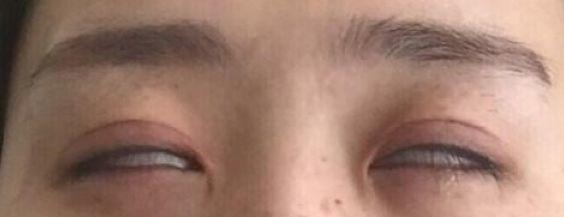 眼睑的位置图片，从上眼睑可以看出身体病症吗