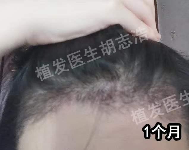 一图解析植发手术全流程，揭秘植发手术的全过程