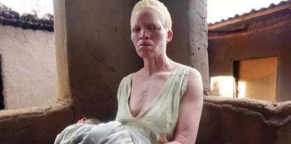 人类白化病的直接原因，非洲的白化病人