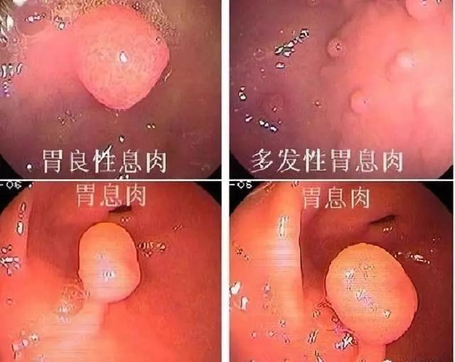 常见的胃息肉，发现这种胃息肉，不一定是坏事