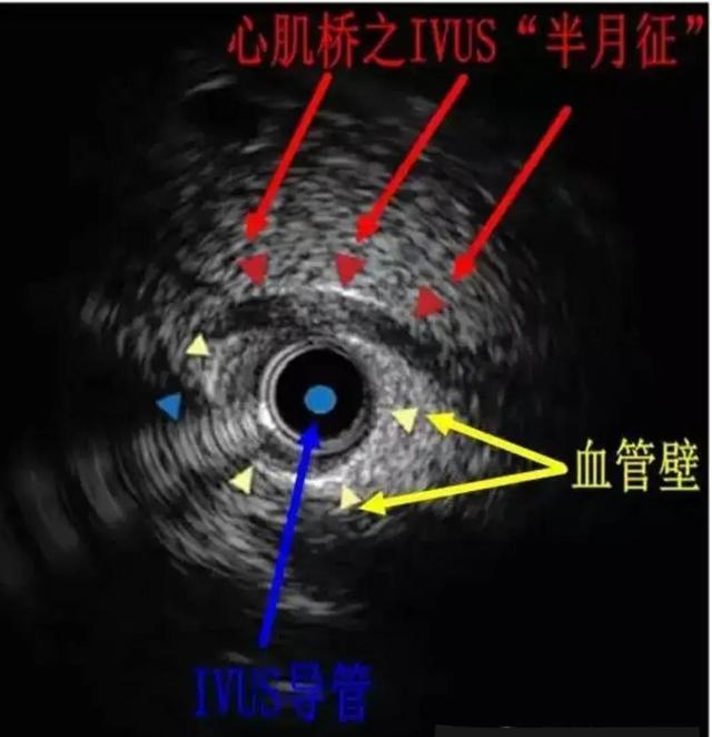 冠状动脉肌桥属于先天性疾病吗，冠状动脉肌桥属于什么病