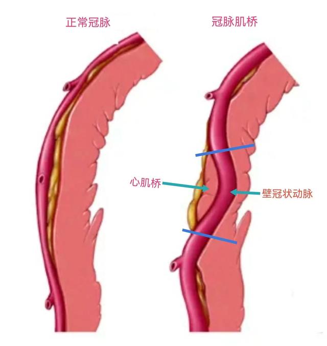 冠状动脉肌桥属于先天性疾病吗，冠状动脉肌桥属于什么病