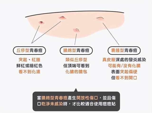 痘痘贴对什么有用，其实遮瑕好过祛痘