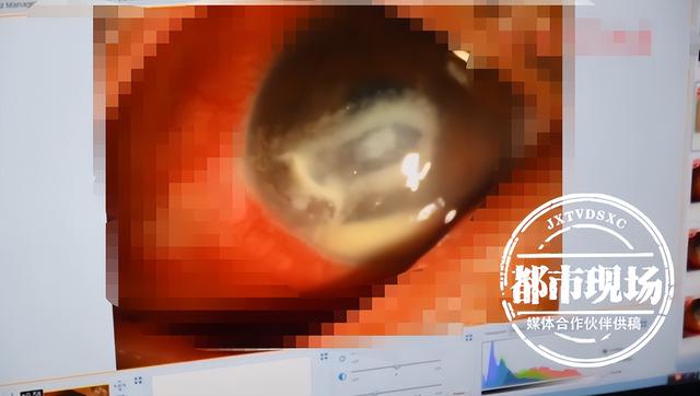 眼睛被虫子撞了会自己好吗，少年这个动作导致角膜溃疡流脓