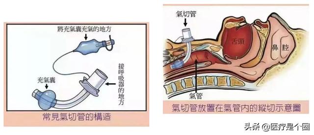 正常人的声带图片，喉咙切开插管能说话吗（关于喉头、声带的10个秘密）