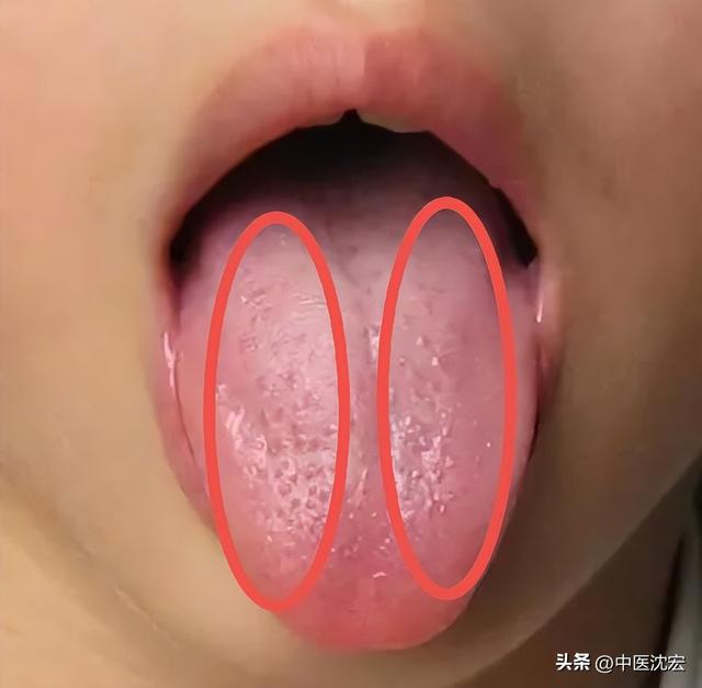 肝郁气滞的症状，肝郁气滞的症状舌头图（肝郁、气滞、痰凝、瘀血是乳腺增生的元凶）