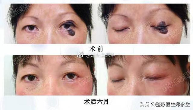 内眼睑长痣如何处理，眼睑分裂痣的分类与治疗方式