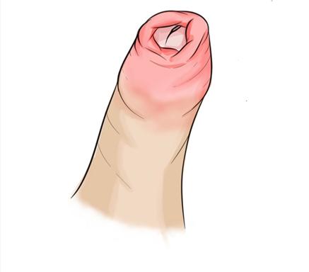 糖尿病对龟头