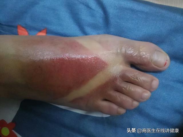糖尿病吃什么药好(糖尿病吃什么药降糖效果好)