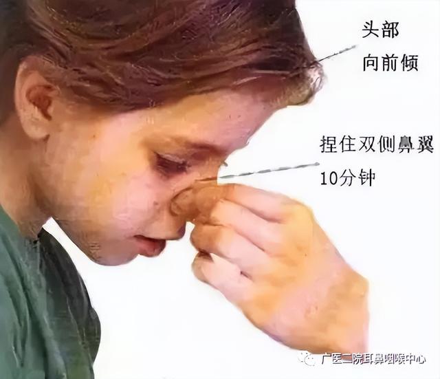 孩子鼻出血正确处理方法，儿童鼻出血的正常处理方式