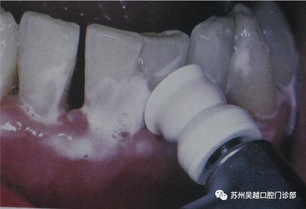 第一次洗牙疼不疼，洗牙疼不疼大概多长时间（分享一下第一次洗牙的经历和感受）