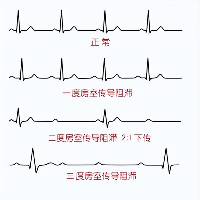 一分钟快速看懂心电图，1分钟教你看懂心电图
