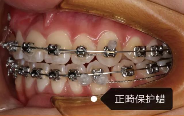 戴牙套后必须要注意的，戴上牙套后如何做好日常护理