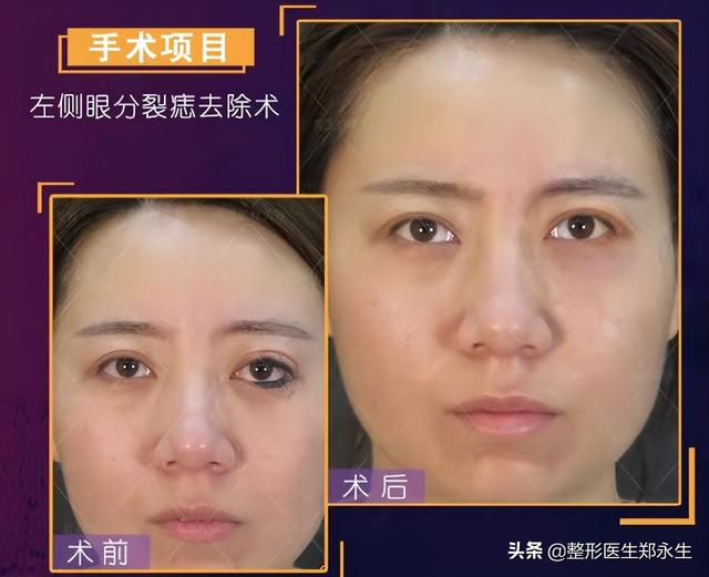 内眼睑长痣如何处理，眼睑分裂痣的分类与治疗方式
