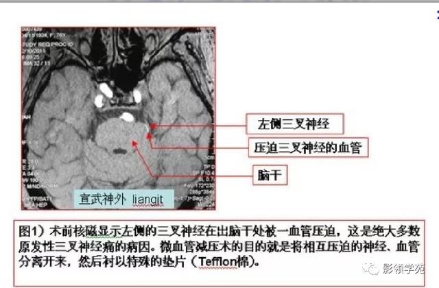 面部血管分布图，三叉神经分支及面部分布规律（玻尿酸怎么打，才会避免栓塞呢）