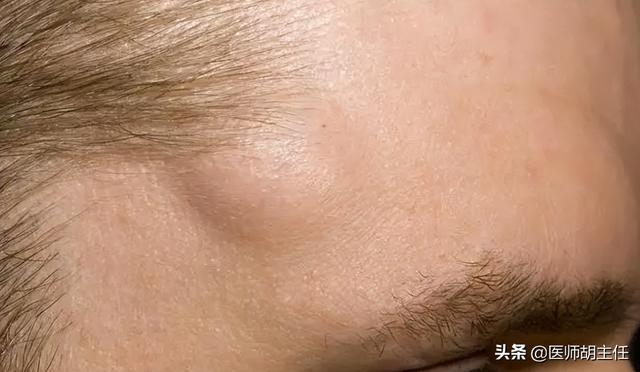 脂肪瘤怎么治疗最好的方法，正常人为什么会出现脂肪瘤