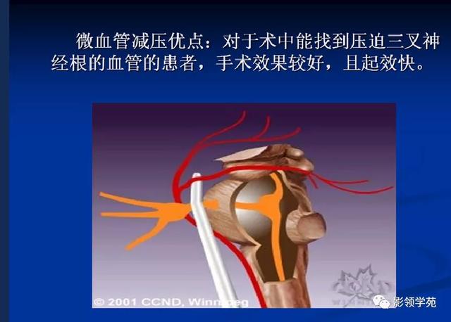 面部血管分布图，三叉神经分支及面部分布规律（玻尿酸怎么打，才会避免栓塞呢）