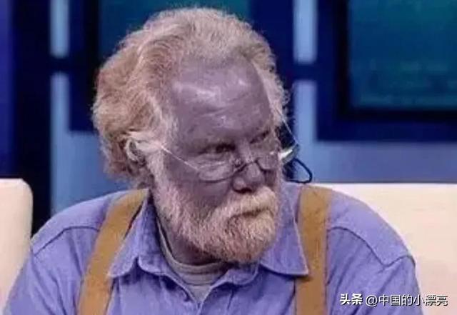 蓝血人到底是什么，世界上真的有蓝血人