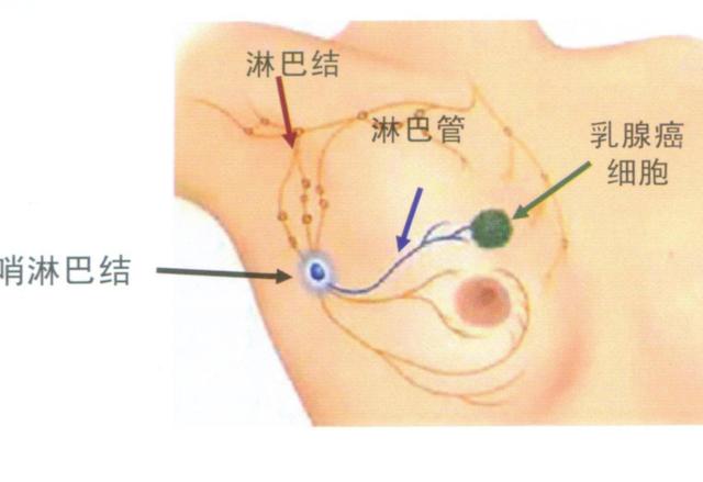 怎么预防乳腺癌，大多数女性都不知道（怎么样分辨乳腺癌是早期和晚期）