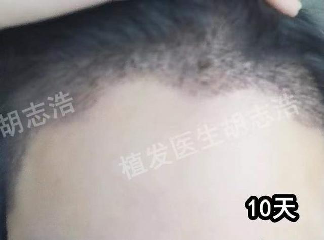 一图解析植发手术全流程，揭秘植发手术的全过程