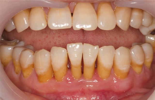 第一次洗牙疼不疼，洗牙疼不疼大概多长时间（分享一下第一次洗牙的经历和感受）