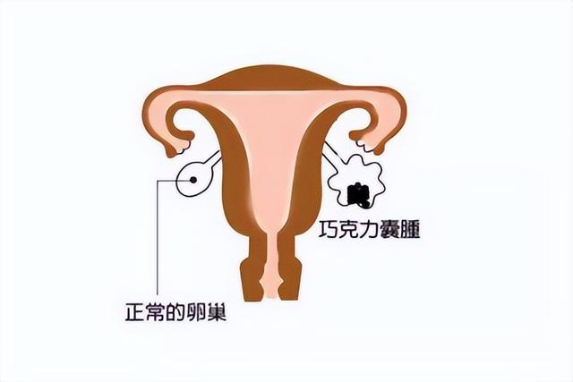 肥胖引起巧囊(肥胖巧克力囊肿)