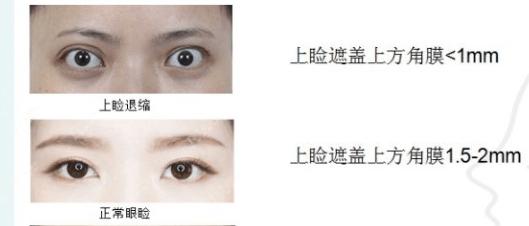 眼睑的位置图片，从上眼睑可以看出身体病症吗