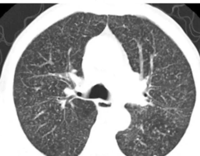 肺结核的分型诊断标准，肺结核的分型及影像学表现