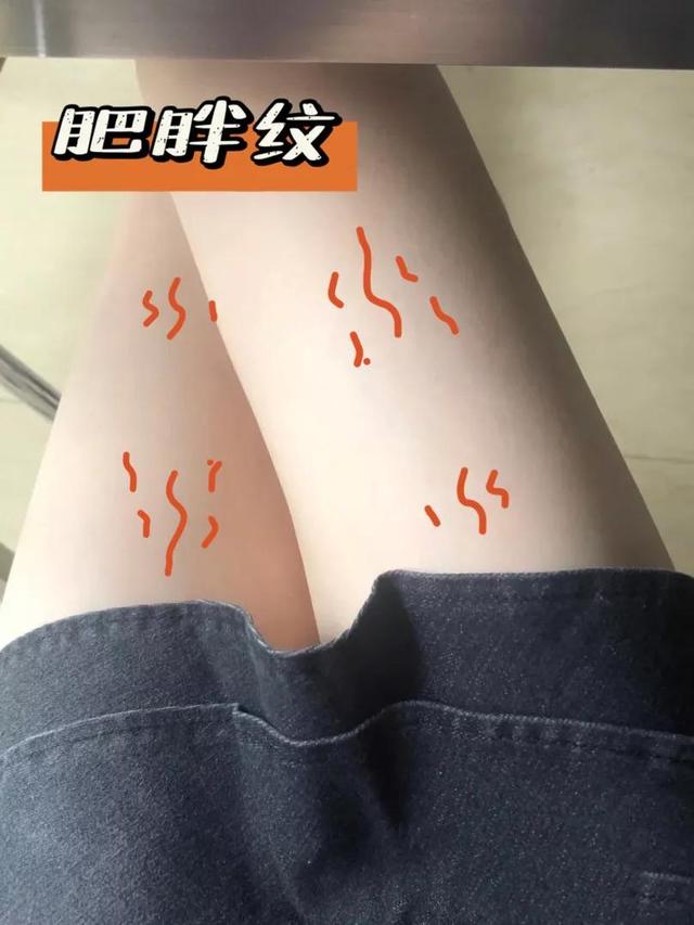 怎么去肥胖纹(怎么去肥胖纹?)